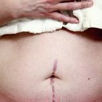 Shane's scar, one year after having right hemicolectomy surgery to remove a portion of small intestine, cecum, appendix, all of the ascending colon and half of the transverse colon. The surgeon also removed a large mass of scar tissue the size of a summer sausage which turned out to be benign. The damage was caused from chronic inflammation from years of suffering with Crohn's Disease.